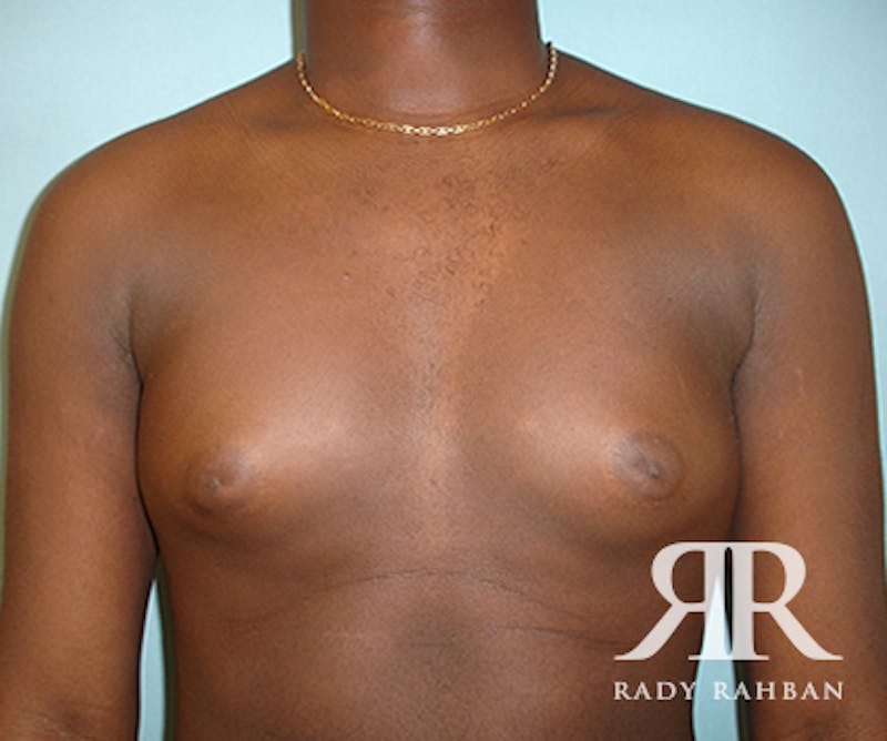 Male Breast Reduction Before & After Gallery - Patient 296372 - Image 1