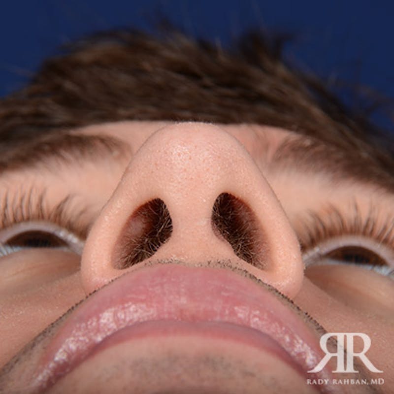 Rhinoplasty w/ Chin Implant Before & After Gallery - Patient 177254 - Image 8