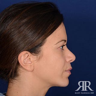 Chin Augmentation Before & After Gallery - Patient 191581 - Image 6
