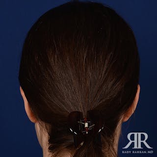 Ear Pinning Surgery Before & After Gallery - Patient 387416 - Image 8