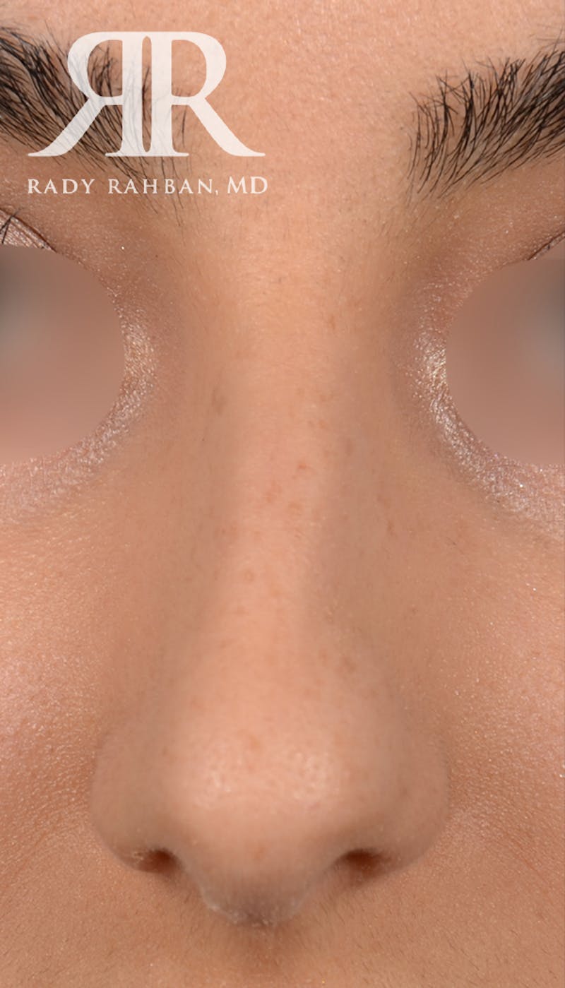 Rhinoplasty Close Up Before & After Gallery - Patient 396865 - Image 3
