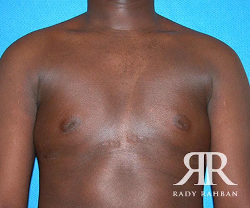 Male Breast Reduction Before & After Gallery - Patient 296372 - Image 2