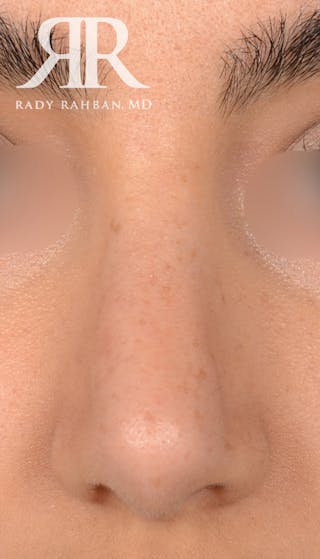Rhinoplasty Close Up Before & After Gallery - Patient 396865 - Image 4