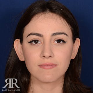 Female Rhinoplasty Before & After Gallery - Patient 392693 - Image 2