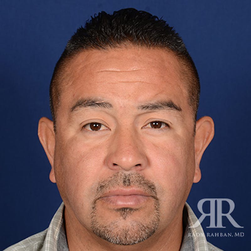 Ear Pinning Surgery Before & After Gallery - Patient 317821 - Image 1