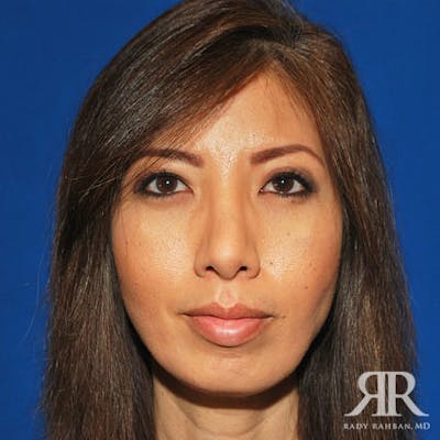 Rhinoplasty w/ Chin Implant Before & After Gallery - Patient 338348 - Image 2