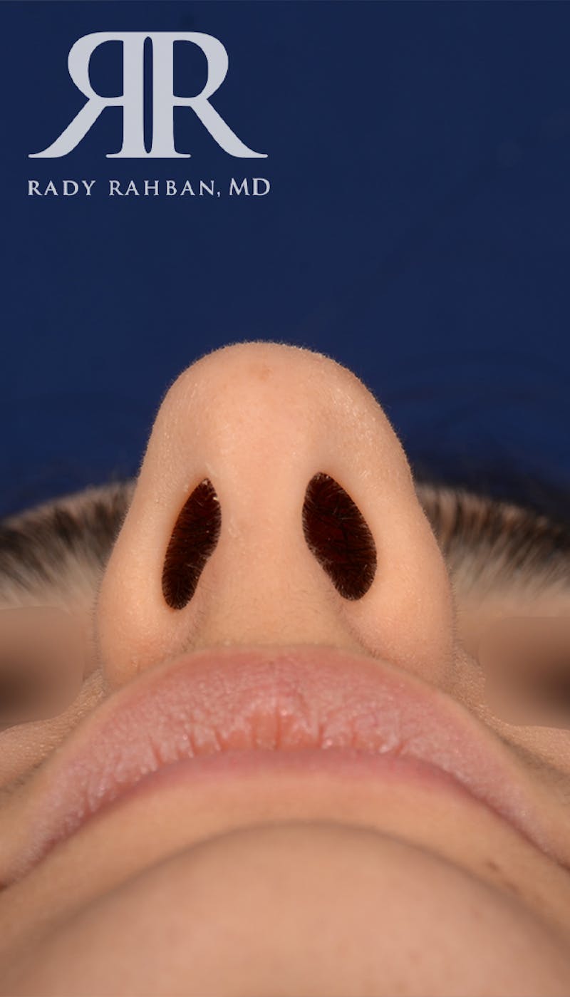 Rhinoplasty Close Up Before & After Gallery - Patient 396865 - Image 5