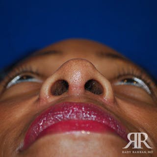 Ethnic Rhinoplasty Before & After Gallery - Patient 931567 - Image 6