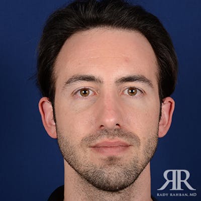 Chin Augmentation Before & After Gallery - Patient 220755 - Image 2