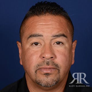 Ear Pinning Surgery Before & After Gallery - Patient 317821 - Image 2