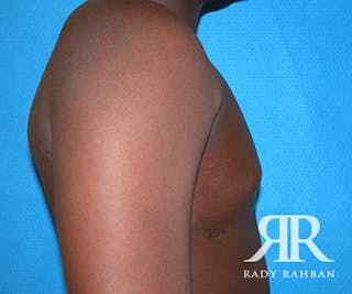 Male Breast Reduction Before & After Gallery - Patient 296372 - Image 4