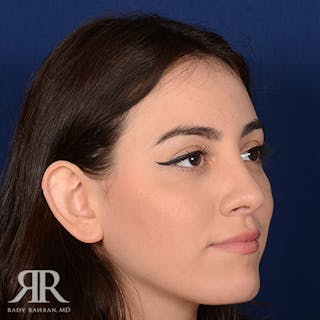 Female Rhinoplasty Before & After Gallery - Patient 392693 - Image 4