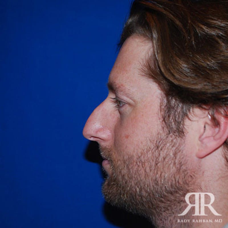 Male Rhinoplasty Before & After Gallery - Patient 333806 - Image 3
