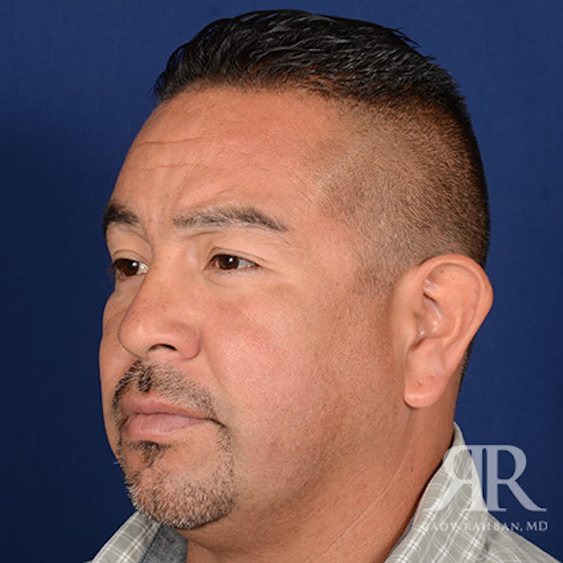 Ear Pinning Surgery Before & After Gallery - Patient 317821 - Image 3