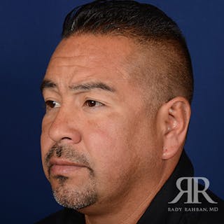 Ear Pinning Surgery Before & After Gallery - Patient 317821 - Image 4