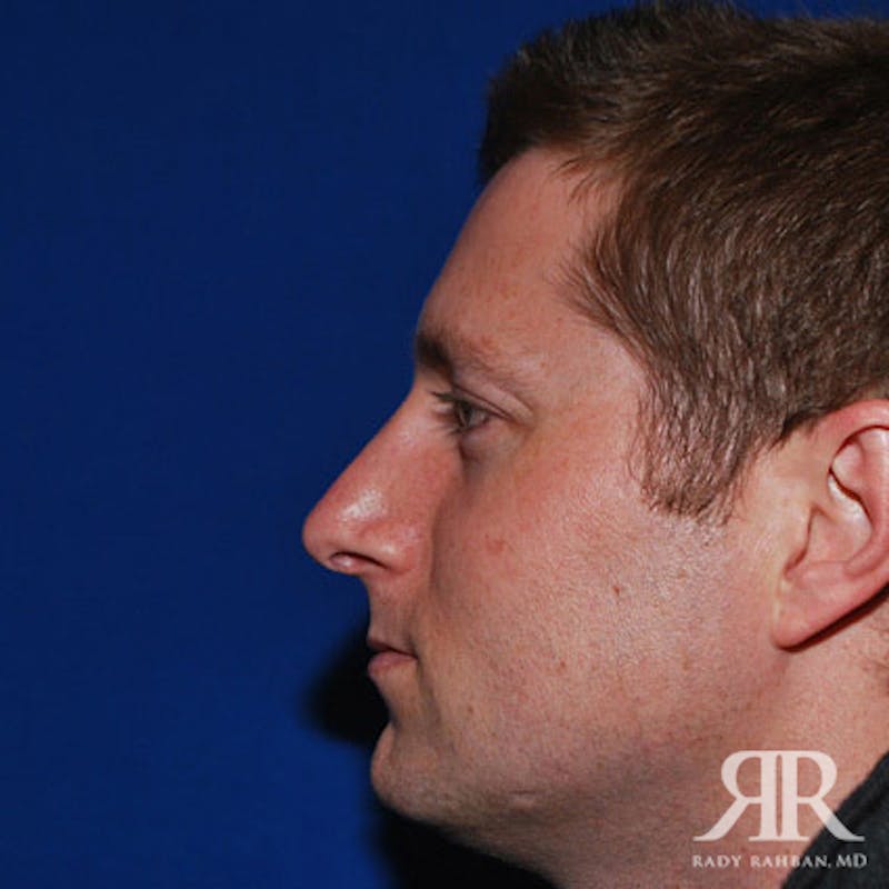 Male Rhinoplasty Before & After Gallery - Patient 333806 - Image 4
