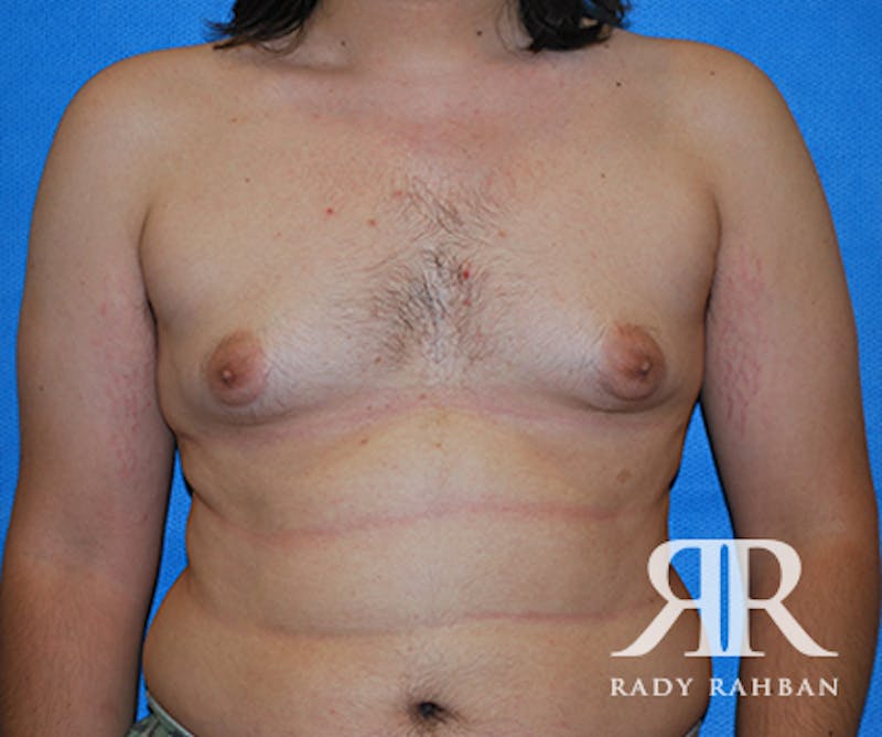 Male Breast Reduction Before & After Gallery - Patient 342745 - Image 1