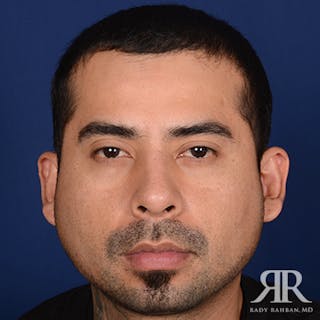 Ethnic Rhinoplasty Before & After Gallery - Patient 123686 - Image 2