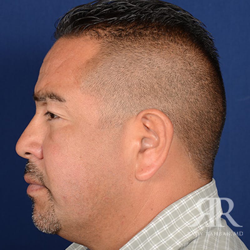 Ear Pinning Surgery Before & After Gallery - Patient 317821 - Image 5
