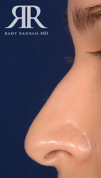 Rhinoplasty Close Up Before & After Gallery - Patient 209710 - Image 1