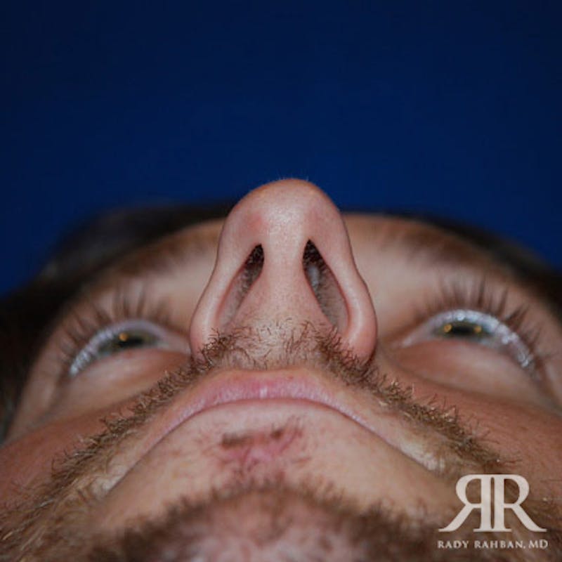 Male Rhinoplasty Before & After Gallery - Patient 333806 - Image 5