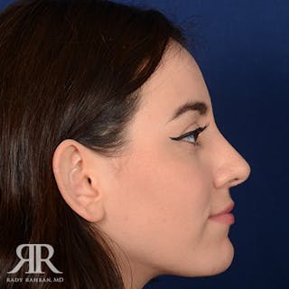Female Rhinoplasty Before & After Gallery - Patient 392693 - Image 6