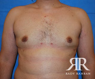 Male Breast Reduction Before & After Gallery - Patient 342745 - Image 2