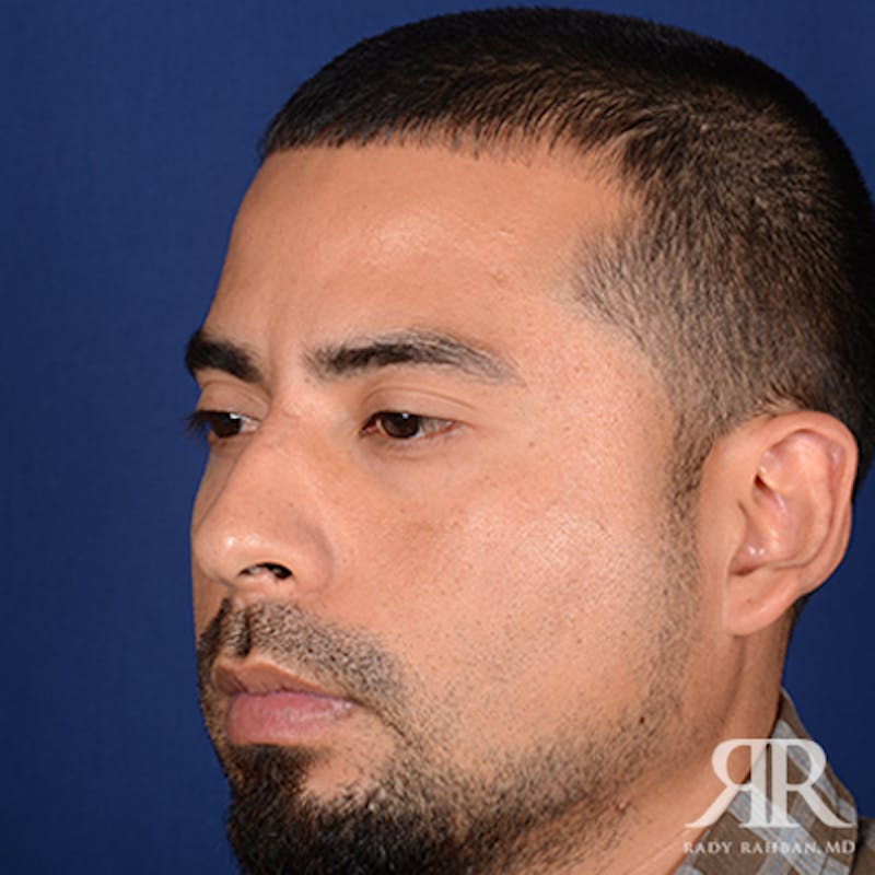 Ethnic Rhinoplasty Before & After Gallery - Patient 123686 - Image 3