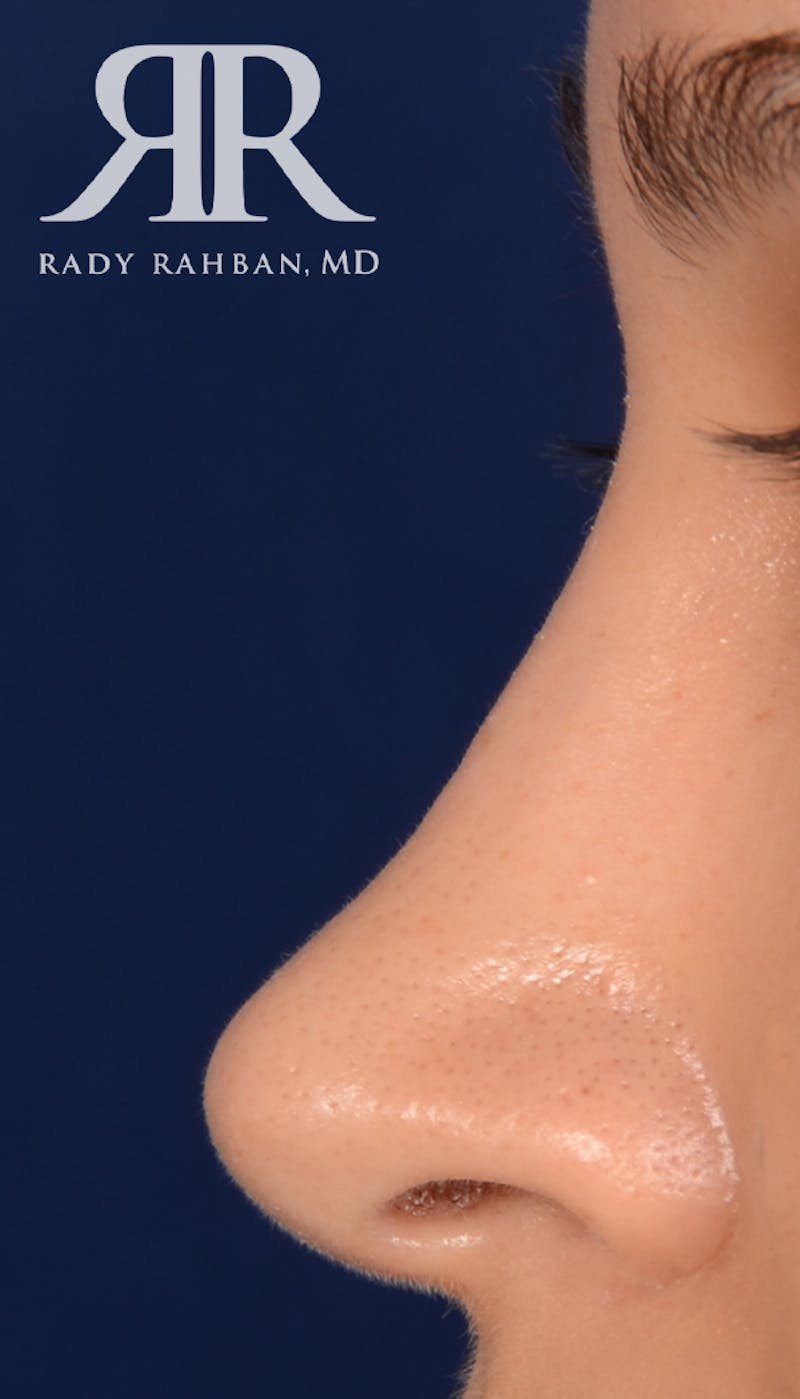 Rhinoplasty Close Up Before & After Gallery - Patient 209710 - Image 2