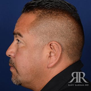 Ear Pinning Surgery Before & After Gallery - Patient 317821 - Image 6