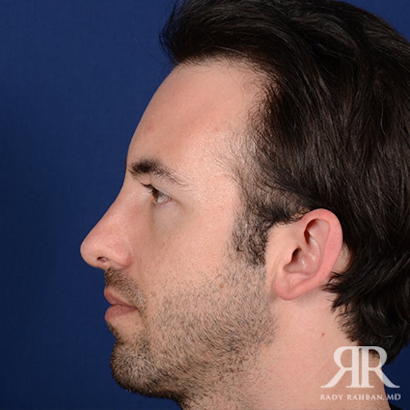 Chin Augmentation Before & After Gallery - Patient 220755 - Image 6