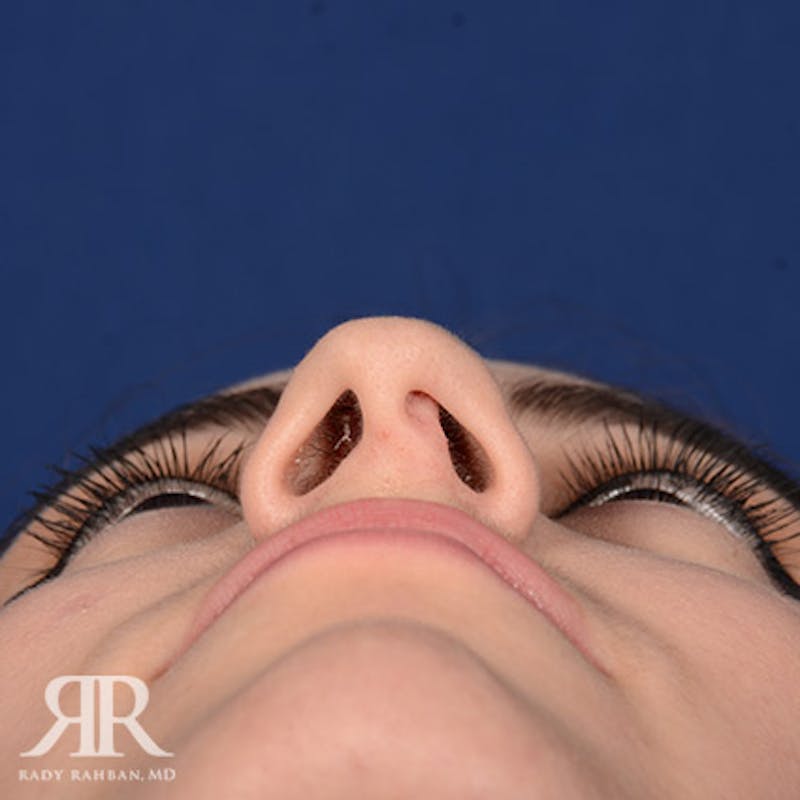 Female Rhinoplasty Before & After Gallery - Patient 392693 - Image 7