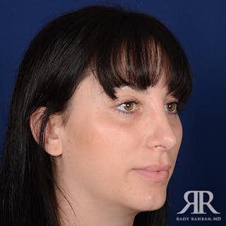 Corrective / Revision Rhinoplasty Before & After Gallery - Patient 260528 - Image 4
