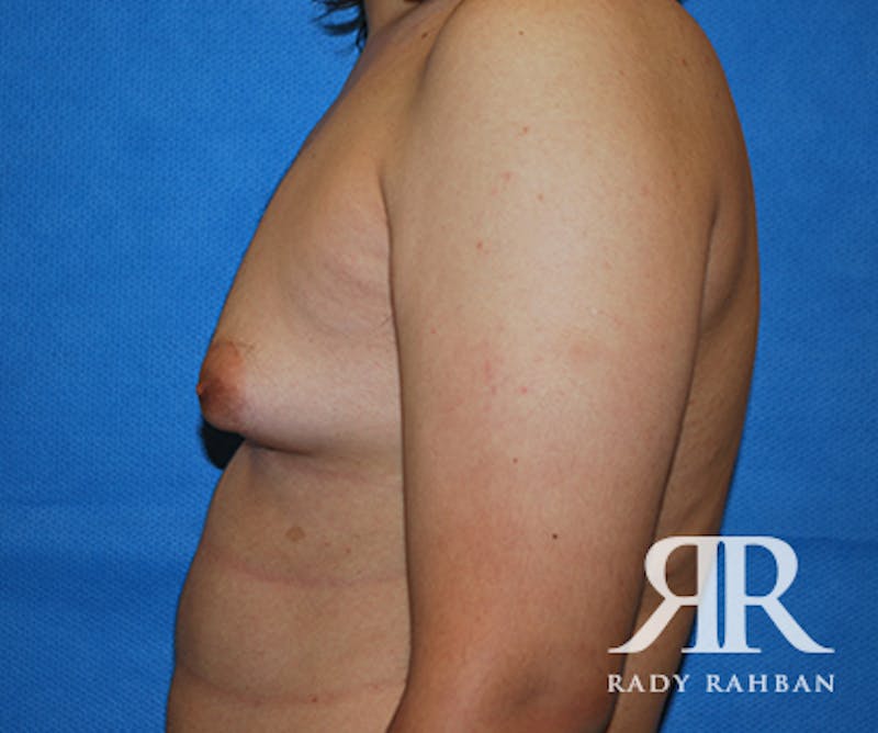Male Breast Reduction Before & After Gallery - Patient 342745 - Image 3