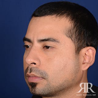 Ethnic Rhinoplasty Before & After Gallery - Patient 123686 - Image 4