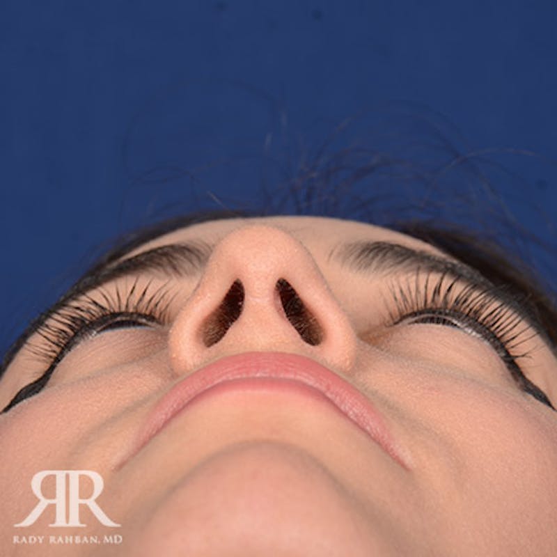 Female Rhinoplasty Before & After Gallery - Patient 392693 - Image 8