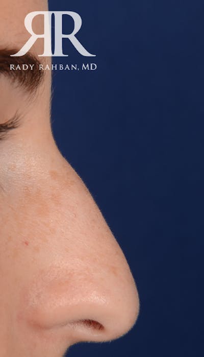 Rhinoplasty Close Up Before & After Gallery - Patient 137029 - Image 1