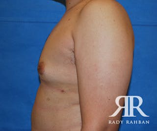Male Breast Reduction Before & After Gallery - Patient 342745 - Image 4