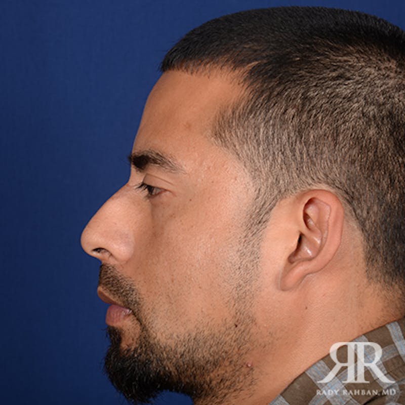 Ethnic Rhinoplasty Before & After Gallery - Patient 123686 - Image 5