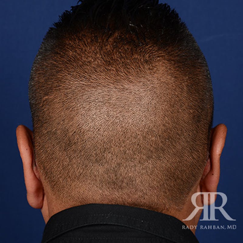 Ear Pinning Surgery Before & After Gallery - Patient 317821 - Image 8