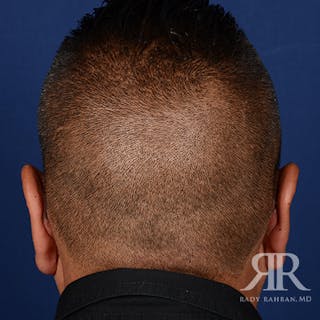 Ear Pinning Surgery Before & After Gallery - Patient 317821 - Image 8