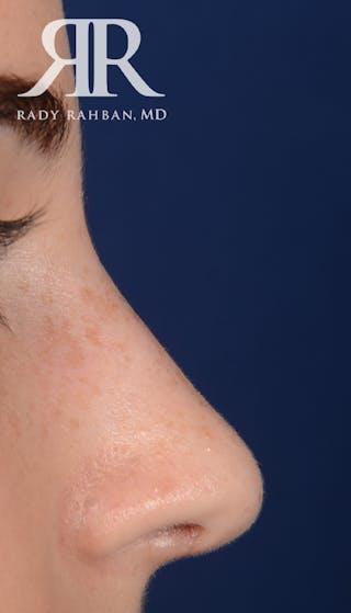 Rhinoplasty Close Up Before & After Gallery - Patient 137029 - Image 2