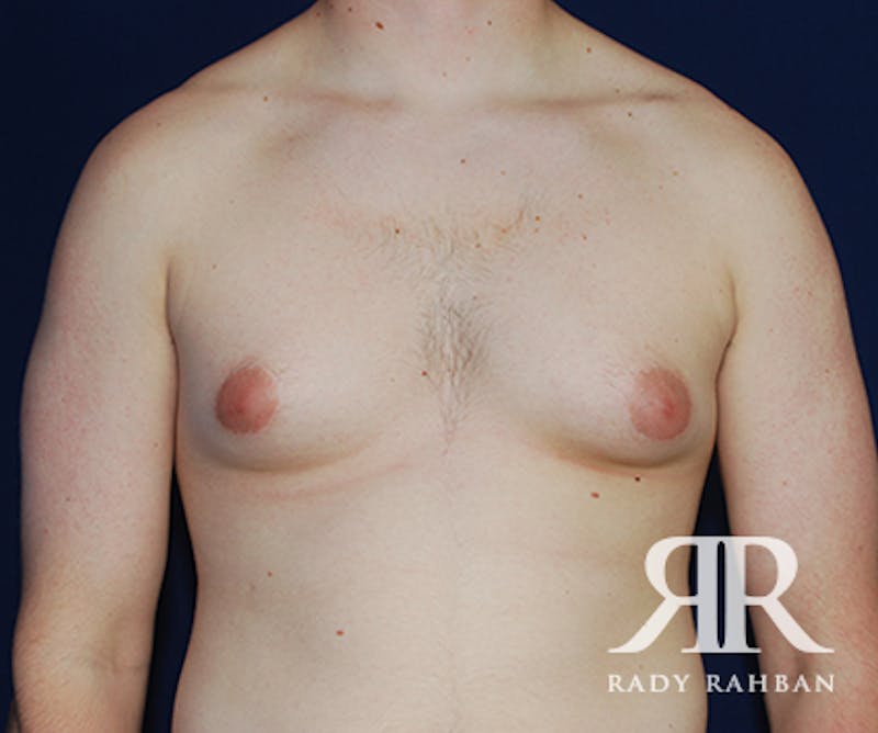 Male Breast Reduction Before & After Gallery - Patient 288166 - Image 1
