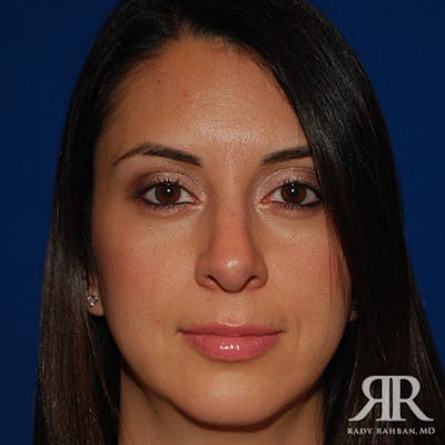 Chin Augmentation Before & After Gallery - Patient 120033 - Image 2
