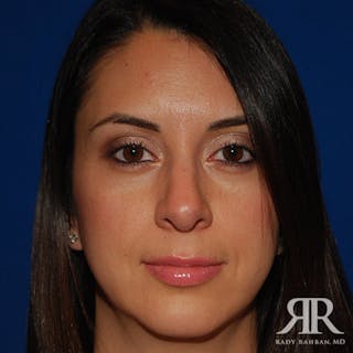 Chin Augmentation Before & After Gallery - Patient 120033 - Image 2