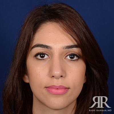 Female Rhinoplasty Before & After Gallery - Patient 142041 - Image 2
