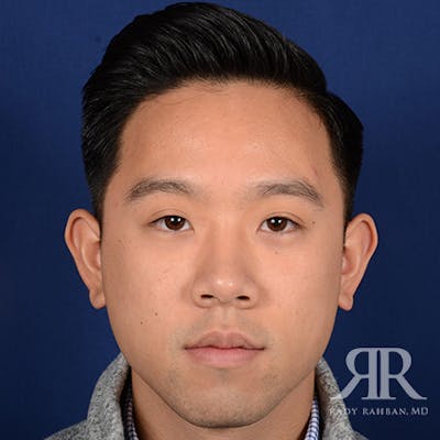 Ear Pinning Surgery Before & After Gallery - Patient 281198 - Image 1