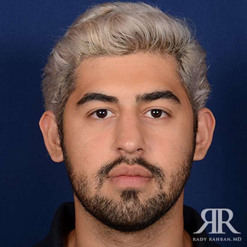 Male Rhinoplasty Before & After Gallery - Patient 109639 - Image 2