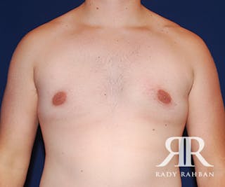 Male Breast Reduction Before & After Gallery - Patient 288166 - Image 2