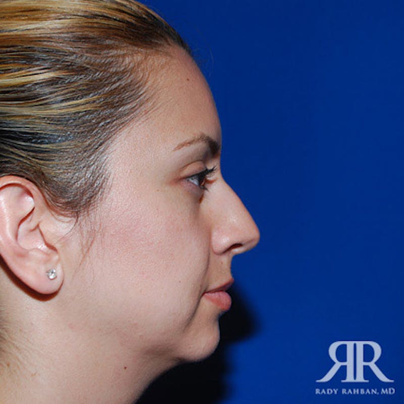 Chin Augmentation Before & After Gallery - Patient 120033 - Image 3